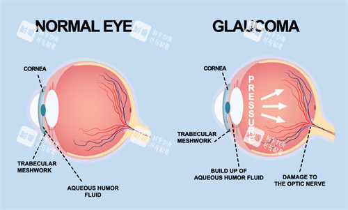 青光眼动画演示图 青光眼动画演示图