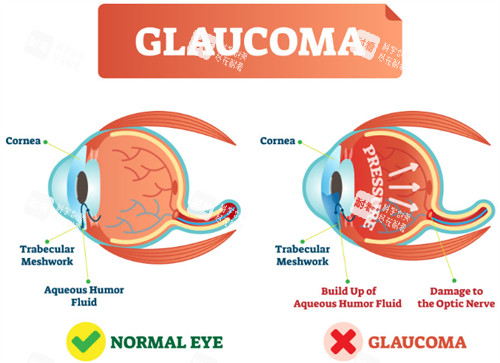 正常眼睛和青光眼的对比 正常眼睛和青光眼的对比
