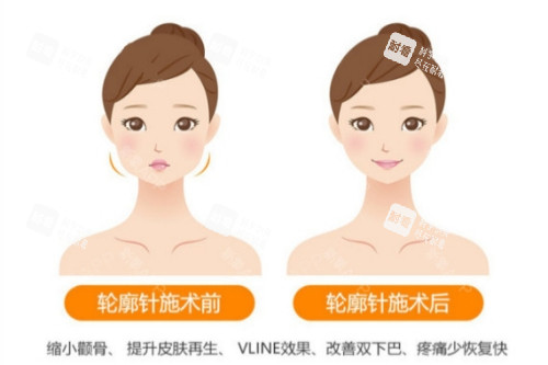 轮廓针卡通对比图