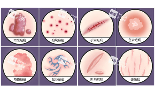 疤痕的种类展示