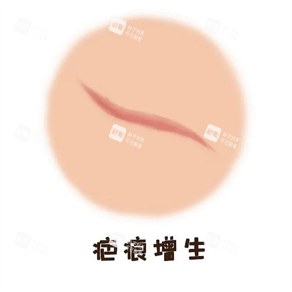 疤痕增生图片