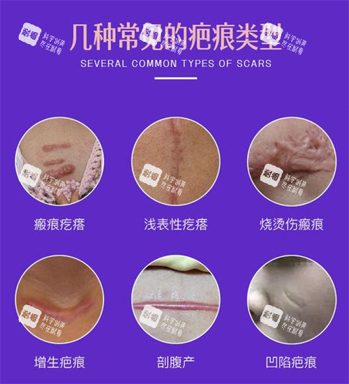 常见的疤痕类型照片