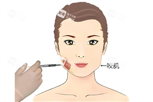 打针瘦脸 打针瘦脸