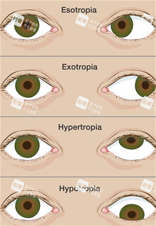 不同程度的斜视眼睛