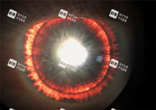 虹膜缺损的眼睛 虹膜缺损的眼睛