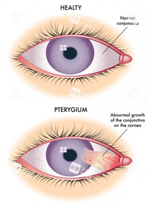 正常眼睛的翼状胬肉 正常眼睛的翼状胬肉