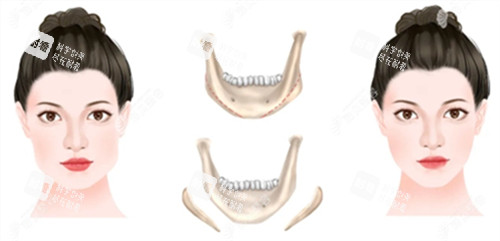 下颌骨截取手术前后对比图