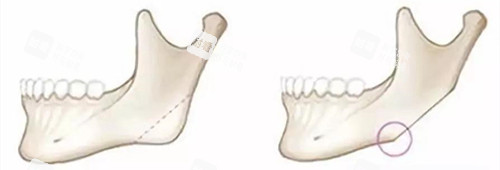 下颌骨切除前后动画演示图