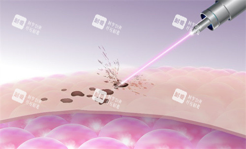 激光祛斑原理图 激光祛斑原理图