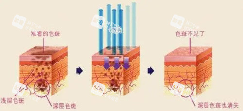 激光祛斑治疗示意图 激光祛斑治疗示意图