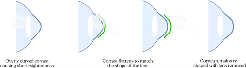 角膜塑形镜改善眼角弧度流程图