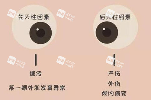 斜视眼睛照片图