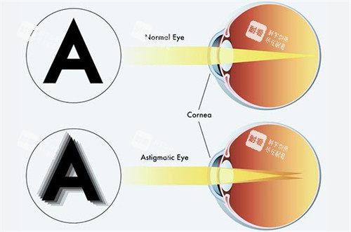 正常眼睛和弱视眼睛成像不同