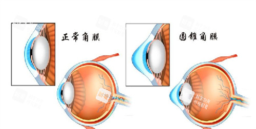 圆锥角膜和正常角膜的区别是什么 圆锥角膜和正常角膜的区别是什么