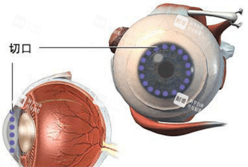 角膜移植手术切口位置图解 角膜移植手术切口位置图解