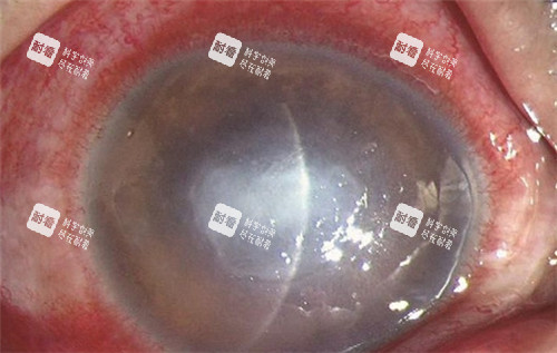 角膜炎图片 角膜炎图片