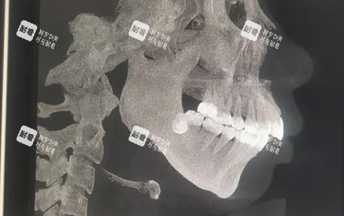 需要做正颌手术的骨骼图