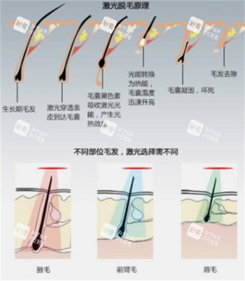 激光脱毛前后对比