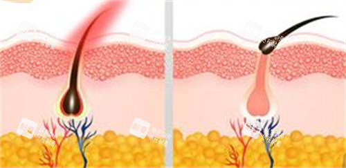 脱毛前后的变化