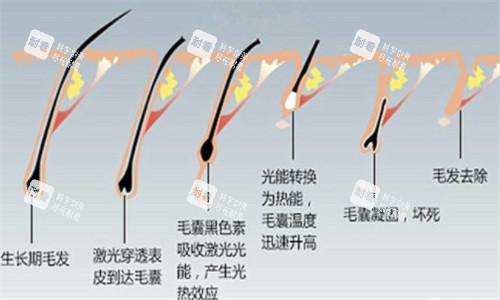 光电仪器脱毛前后对比
