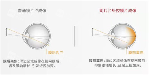 明月轻松控镜片成像