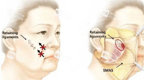 筋膜悬吊怎么做的