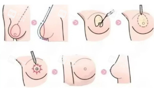 穆大力缩胸手术收费标准：5万起+下垂矫正联合术价格明细