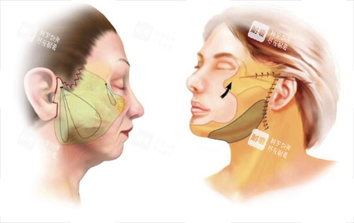 拉皮手术面部脂肪组织区域圈画图