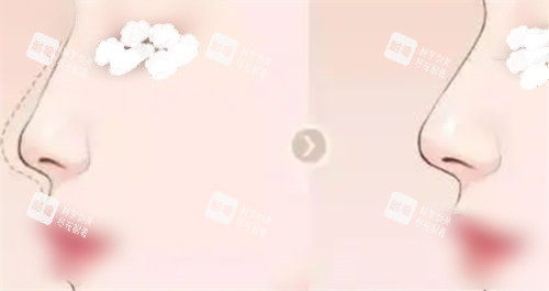 隆鼻鼻部鼻梁术前术后展示图