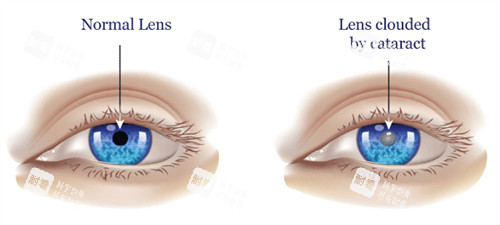 【兰大二院眼科24小时人工客服问询热线】兰大二院眼科电话询问号码24小时在线解答眼科问题！