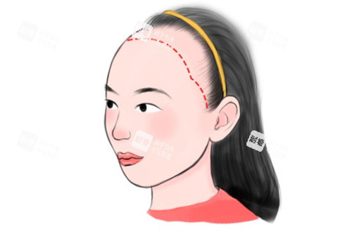 女型发际线种植卡通