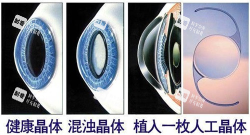 ICL晶体植入眼球对比示意图 ICL晶体植入眼球对比示意图