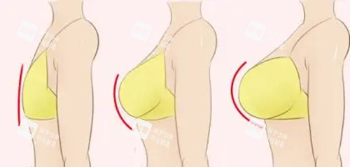 胸部整形卡通示意图