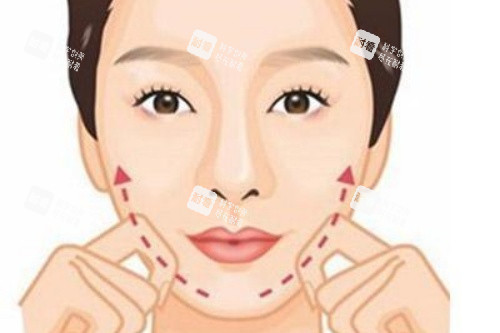 颊脂垫祛除术后卡通图 颊脂垫祛除术后卡通图