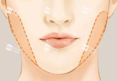 颊脂垫正面位置示意图 颊脂垫正面位置示意图