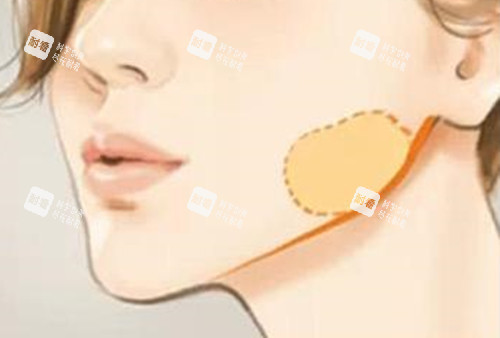 颊脂垫侧面位置示意图 颊脂垫侧面位置示意图