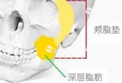 颊脂垫位置示意图 颊脂垫位置示意图
