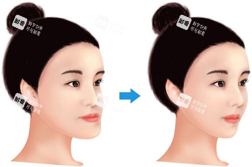 牙齿反颌面型差异