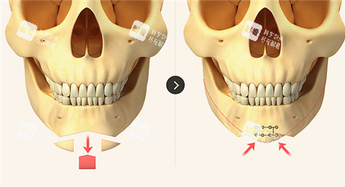 下巴整形环骨骼变化图