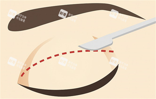 双眼皮的切口切线