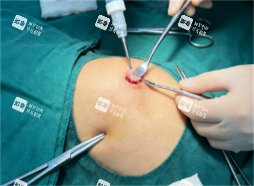 奥美定取出过程