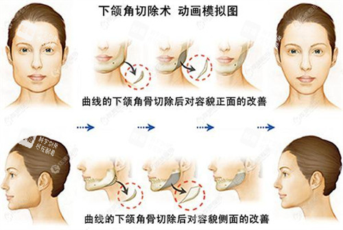 下颌角切除术动画模拟图