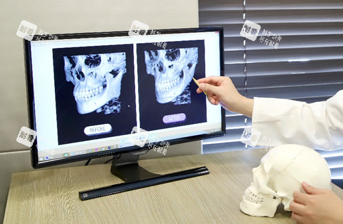 下颌角手术设计图