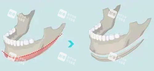 下颌角长曲线截骨前后对比
