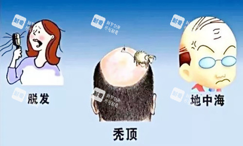 脱发图示