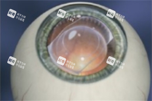 ICL晶体植入完成