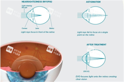 ICL晶体原理解析
