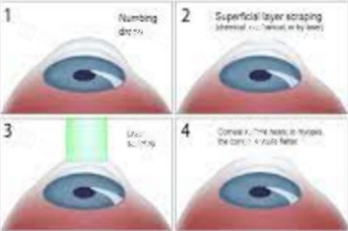 smart全激光手术过程 smart全激光手术过程