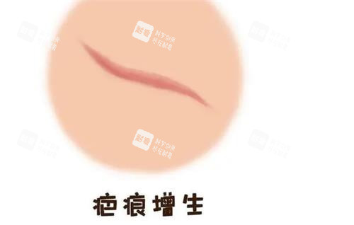 疤痕增生图示 疤痕增生图示