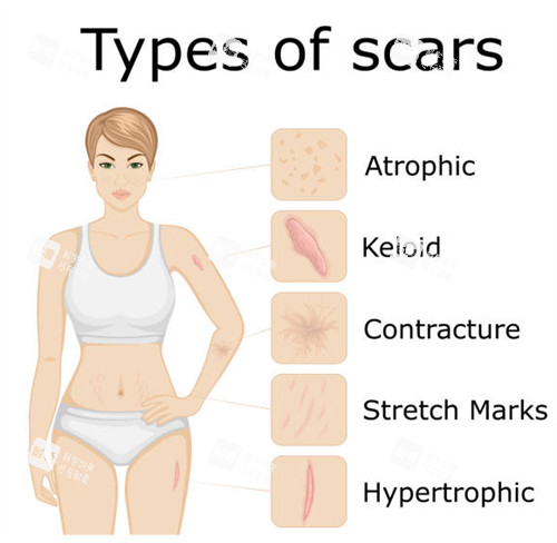 疤痕疙瘩4 疤痕疙瘩4